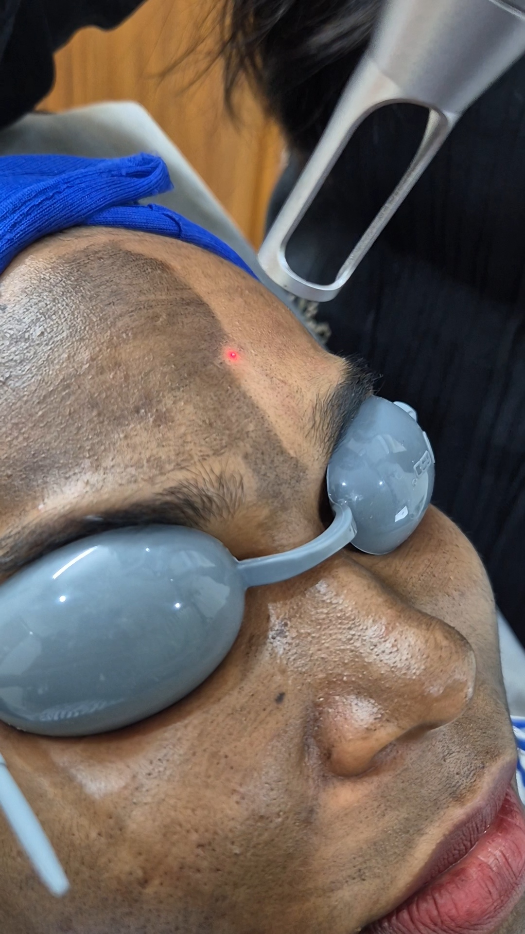 Carbon Laser Peel Story